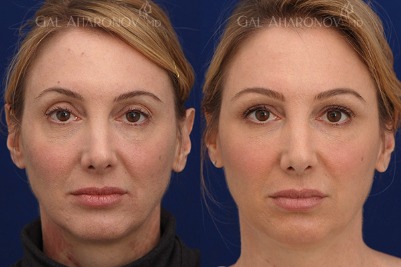Temple and Forehead Filler | Plastic Surgery