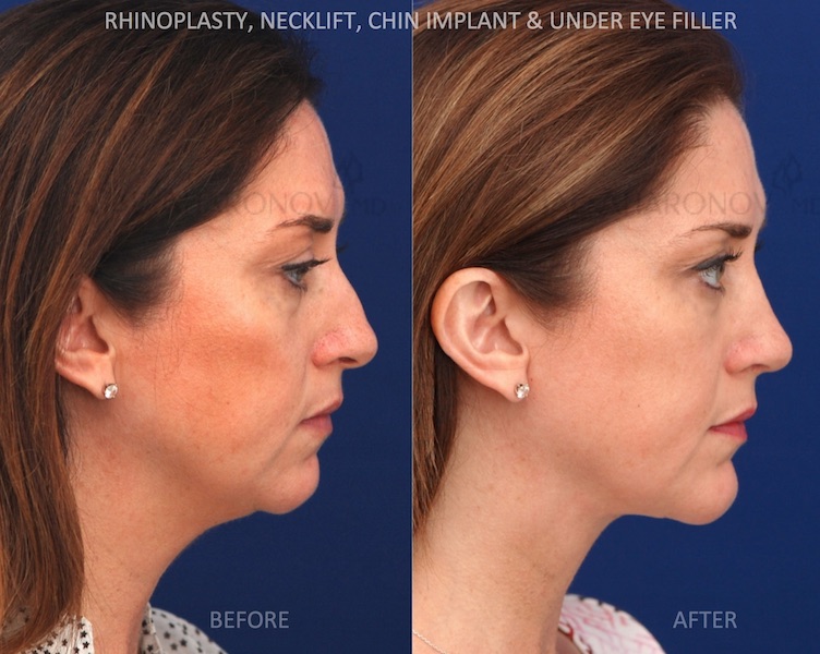 Rhinoplasty combined with a chin implant and a minimal incision necklift. 