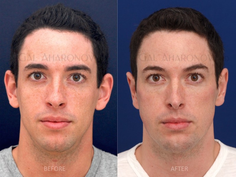 Before & after facial implants & augmentation photos.