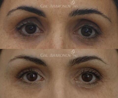 Upper Eyelid & Under Eye Filler | Plastic Surgery