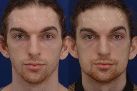 Facial Implants | Plastic Surgery