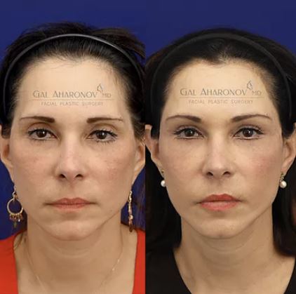 Filler In Temples Before And After  Before And After